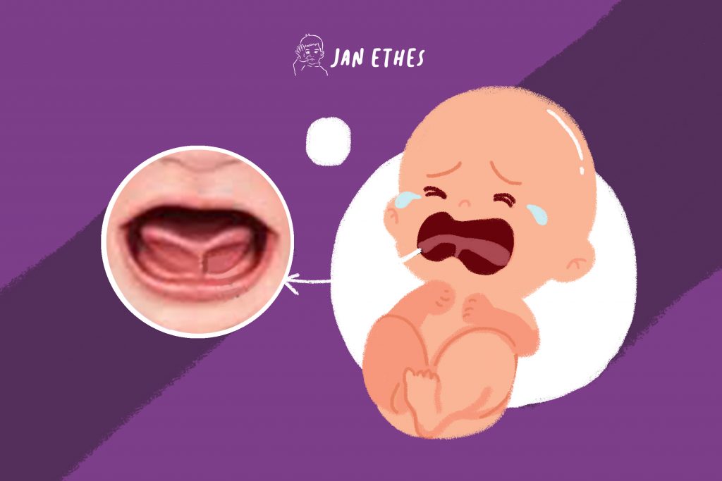 Mengenal Tongue Tie pada Bayi